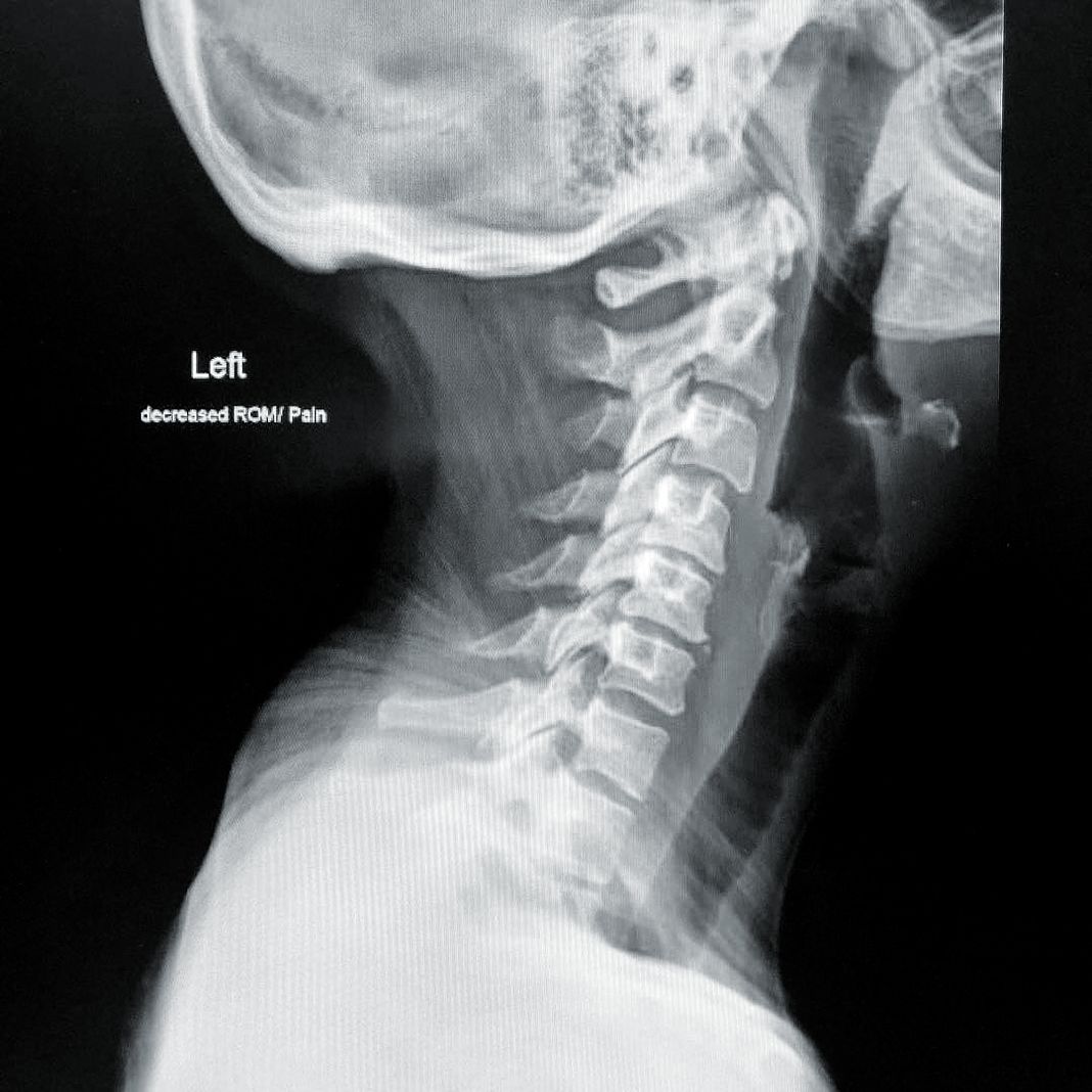 Боль в шее была настолько сильной, что мне наконец сделали рентген.